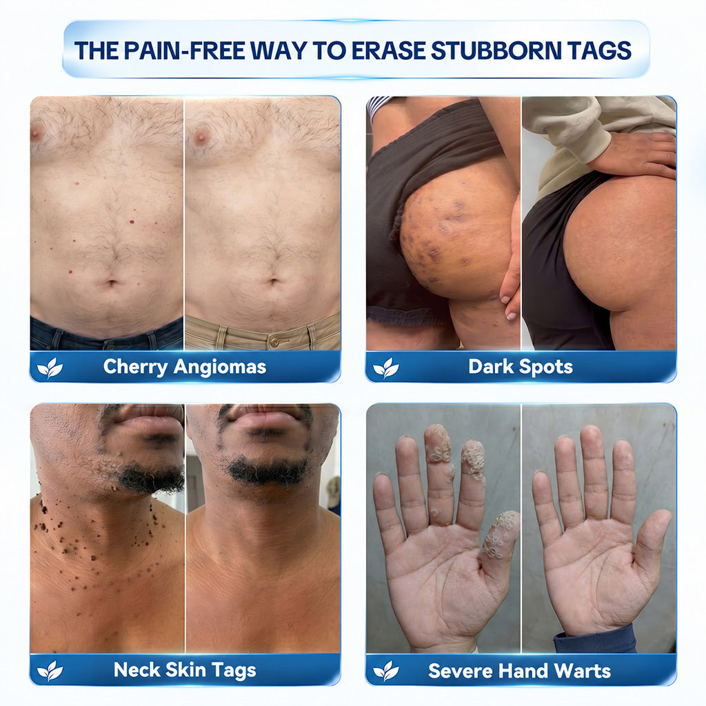 Dyceco® 🚑 | 7-𝐃𝐚𝐲 𝐒𝐤𝐢𝐧 𝐓𝐚𝐠 & 𝐒𝐩𝐨𝐭 𝐄𝐫𝐚𝐬𝐞𝐫 𝐂𝐫𝐞𝐚𝐦 (Zero Pain, Zero 𝐒𝐜𝐚𝐫𝐬 Formula)