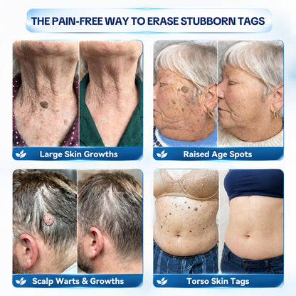 Dyceco® 🚑 | 7-𝐃𝐚𝐲 𝐒𝐤𝐢𝐧 𝐓𝐚𝐠 & 𝐒𝐩𝐨𝐭 𝐄𝐫𝐚𝐬𝐞𝐫 𝐂𝐫𝐞𝐚𝐦 (Zero Pain, Zero 𝐒𝐜𝐚𝐫𝐬 Formula)