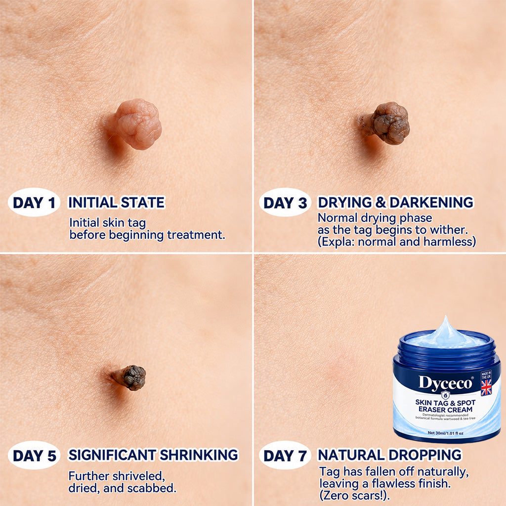 Dyceco® 🚑 | 7-𝐃𝐚𝐲 𝐒𝐤𝐢𝐧 𝐓𝐚𝐠 & 𝐒𝐩𝐨𝐭 𝐄𝐫𝐚𝐬𝐞𝐫 𝐂𝐫𝐞𝐚𝐦 (Zero Pain, Zero 𝐒𝐜𝐚𝐫𝐬 Formula)